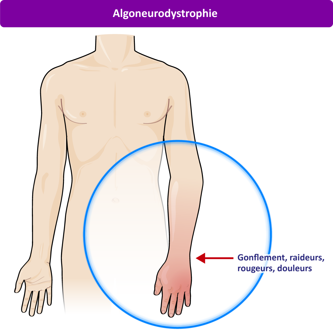 Syndrome Douloureux R Gional Complexe Sdrc R Seau Main Idf